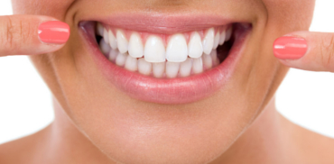 Servicii de albire dentara in Timisoara