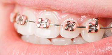 Aparate dentare pentru copii Timisoara