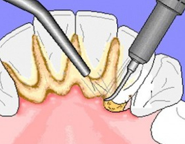 Identificarea placii dentare pentru copii